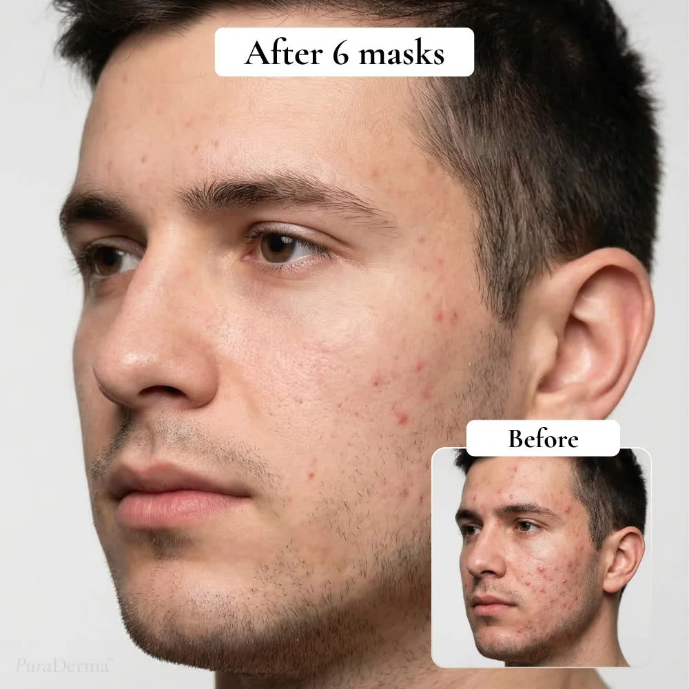 Full-Face Pimple Hydrocolloid Mask