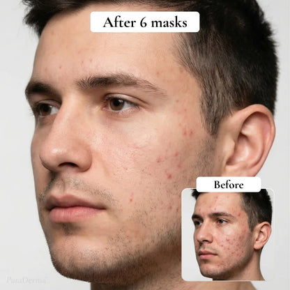 Full-Face Pimple Hydrocolloid Mask