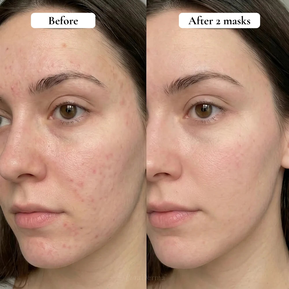 Full-Face Pimple Hydrocolloid Mask